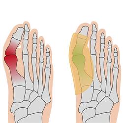 Hallux Polster , 1 Paar